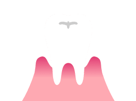 画像：歯周病のイメージ